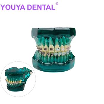 Ортодонтическая модель зубов С металлокерамическими брекетами Кронштейн для изучения медицинских стоматологических заболеваний Модель зубного имплантата